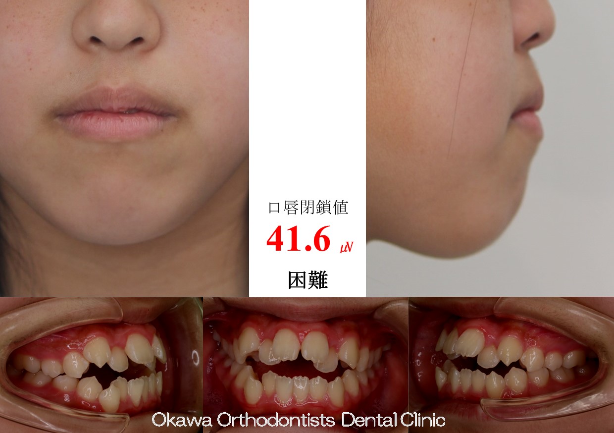 735. 外科ケースを矯正のみでの Before 画像