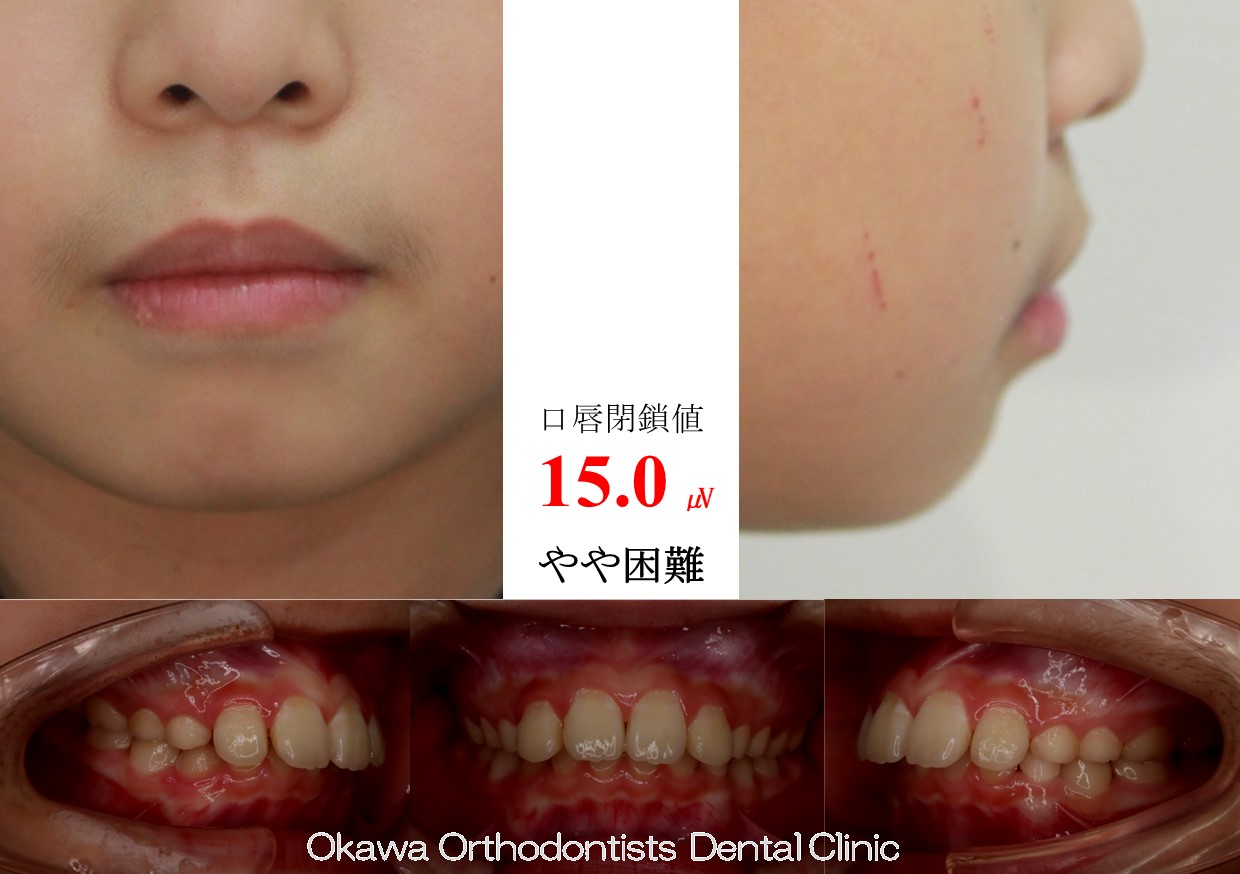 738. 結局非抜歯での Before 画像