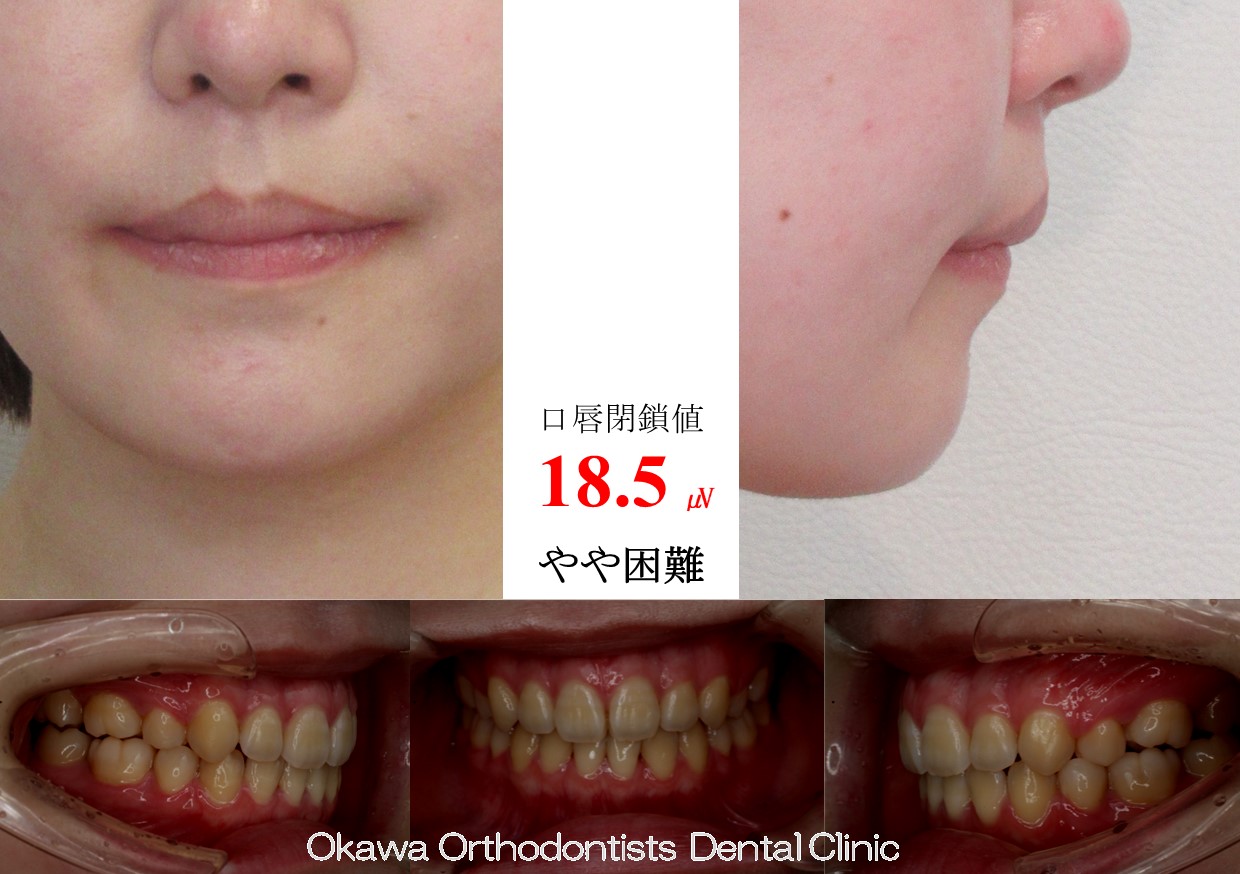 737. 右側切歯クロスバイトの After 画像