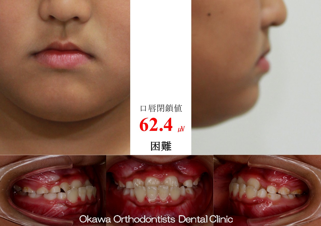 742. 外科併用やめて非抜歯での Before 画像