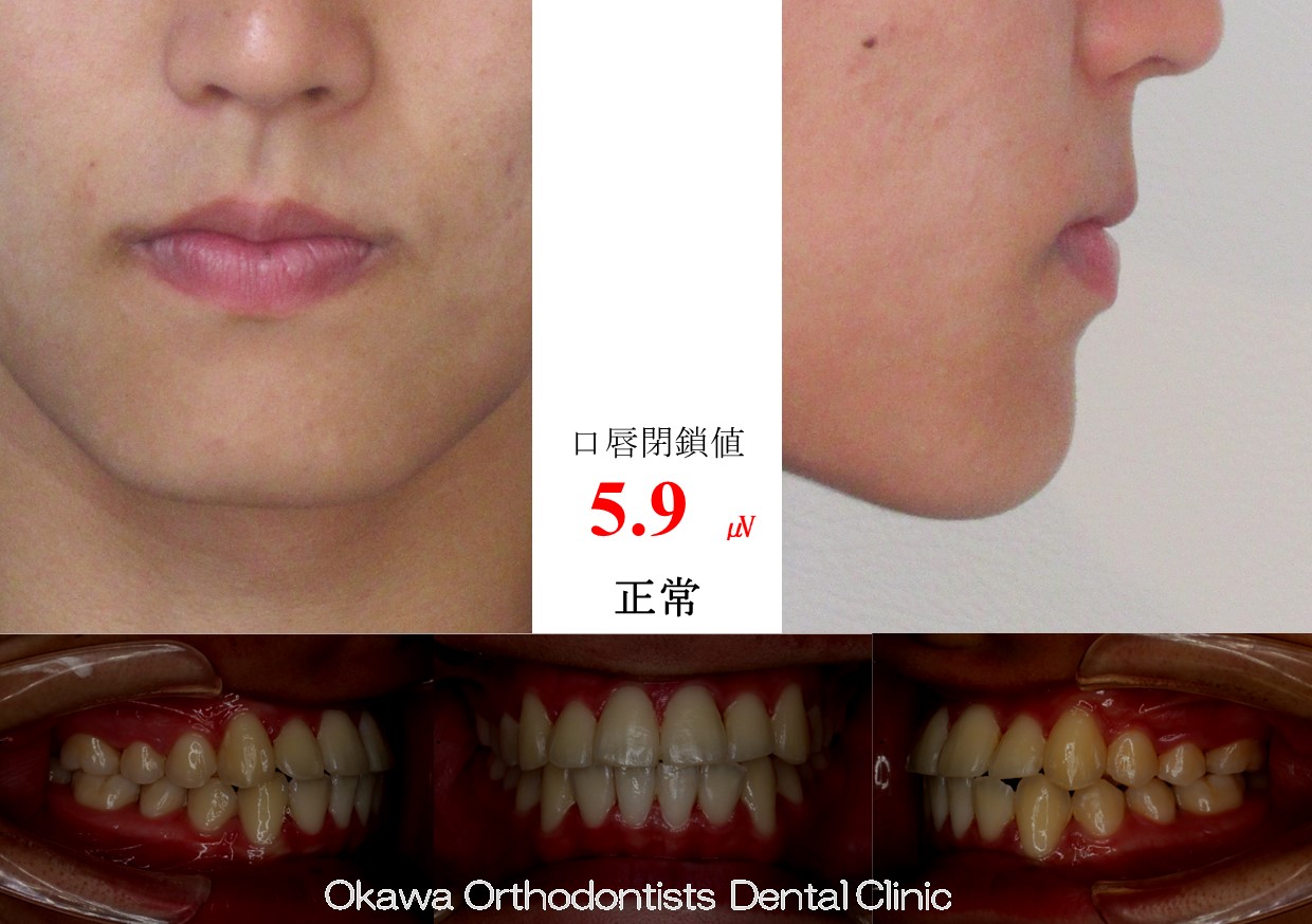 742. 外科併用やめて非抜歯での After 画像