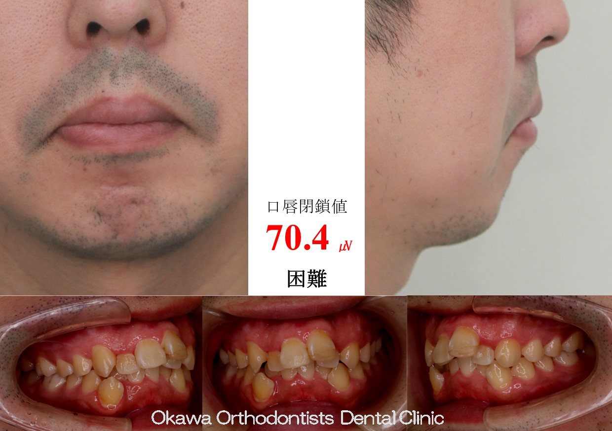 744. ３０代男性の叢生の Before 画像