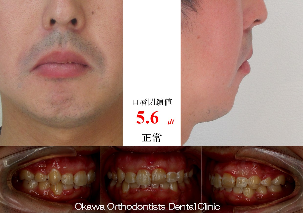 744. ３０代男性の叢生の After 画像