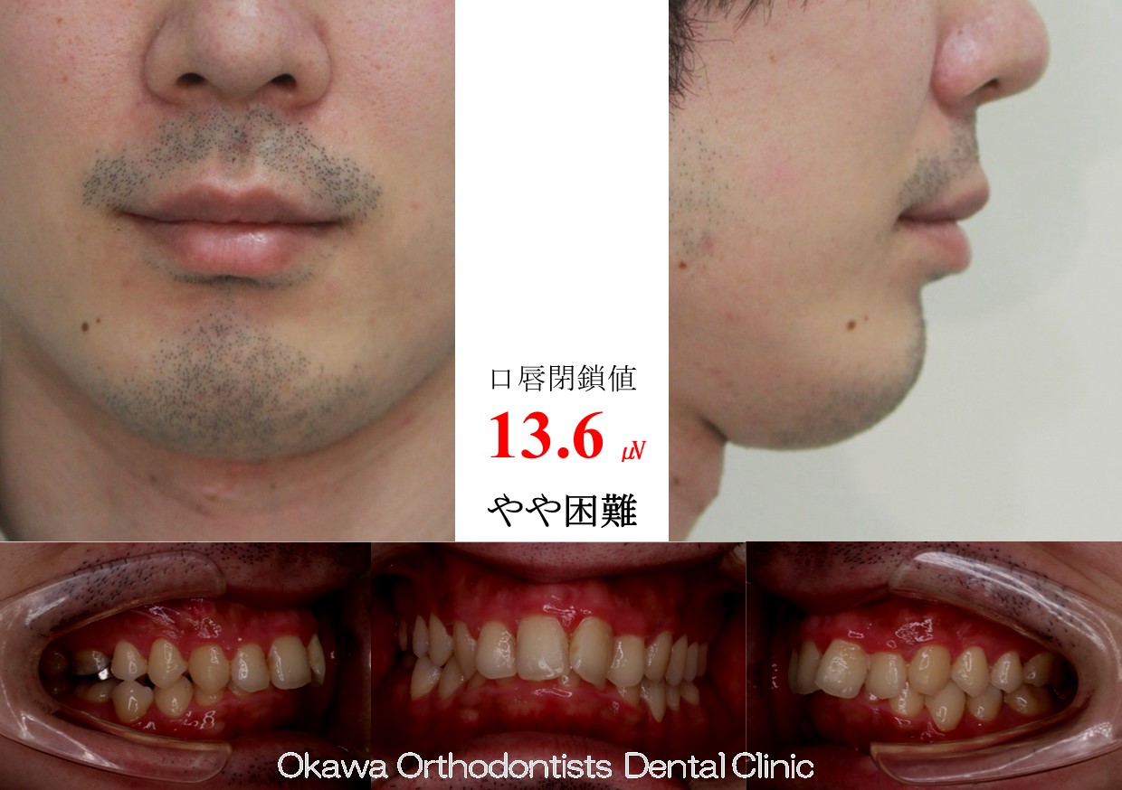 745. 上顎前突、叢生を非抜歯での Before 画像