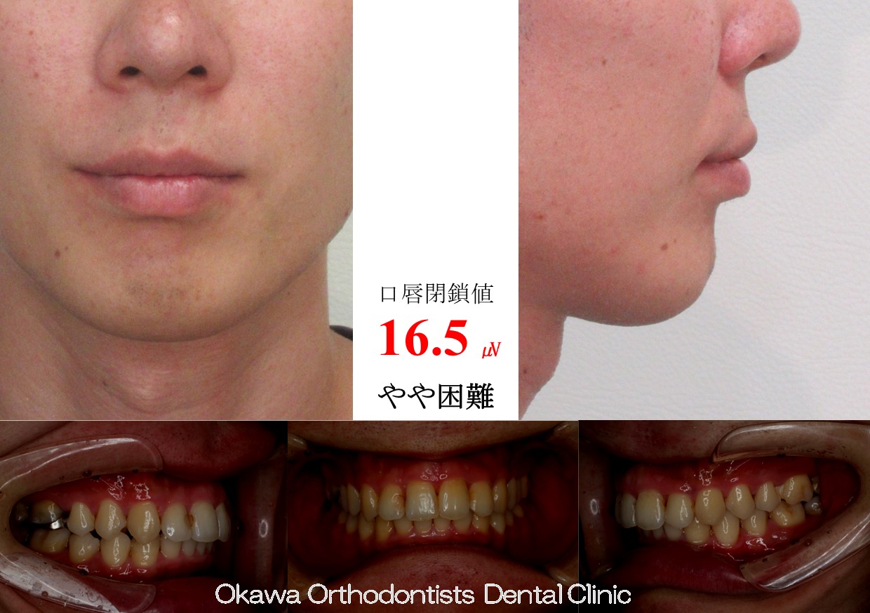 745. 上顎前突、叢生を非抜歯での After 画像