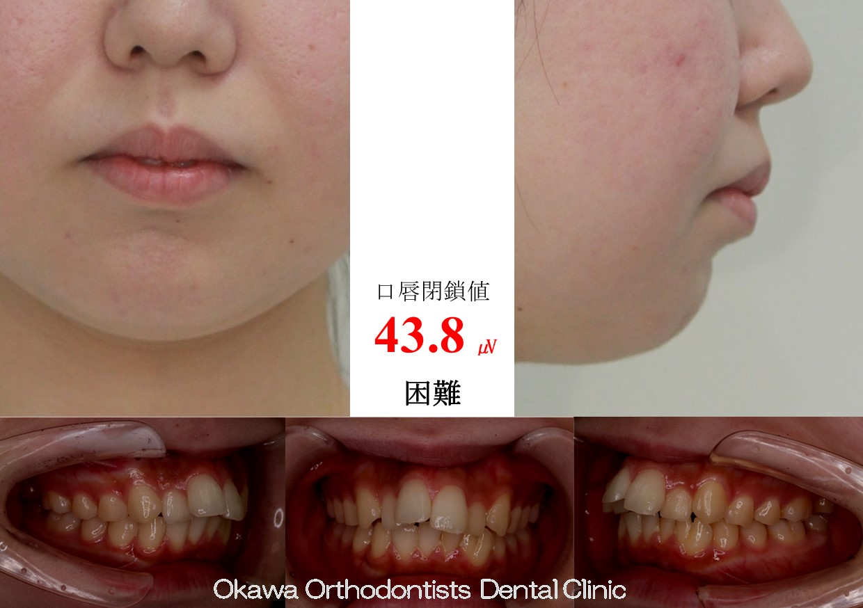 743. 叢生と癒合歯の Before 画像