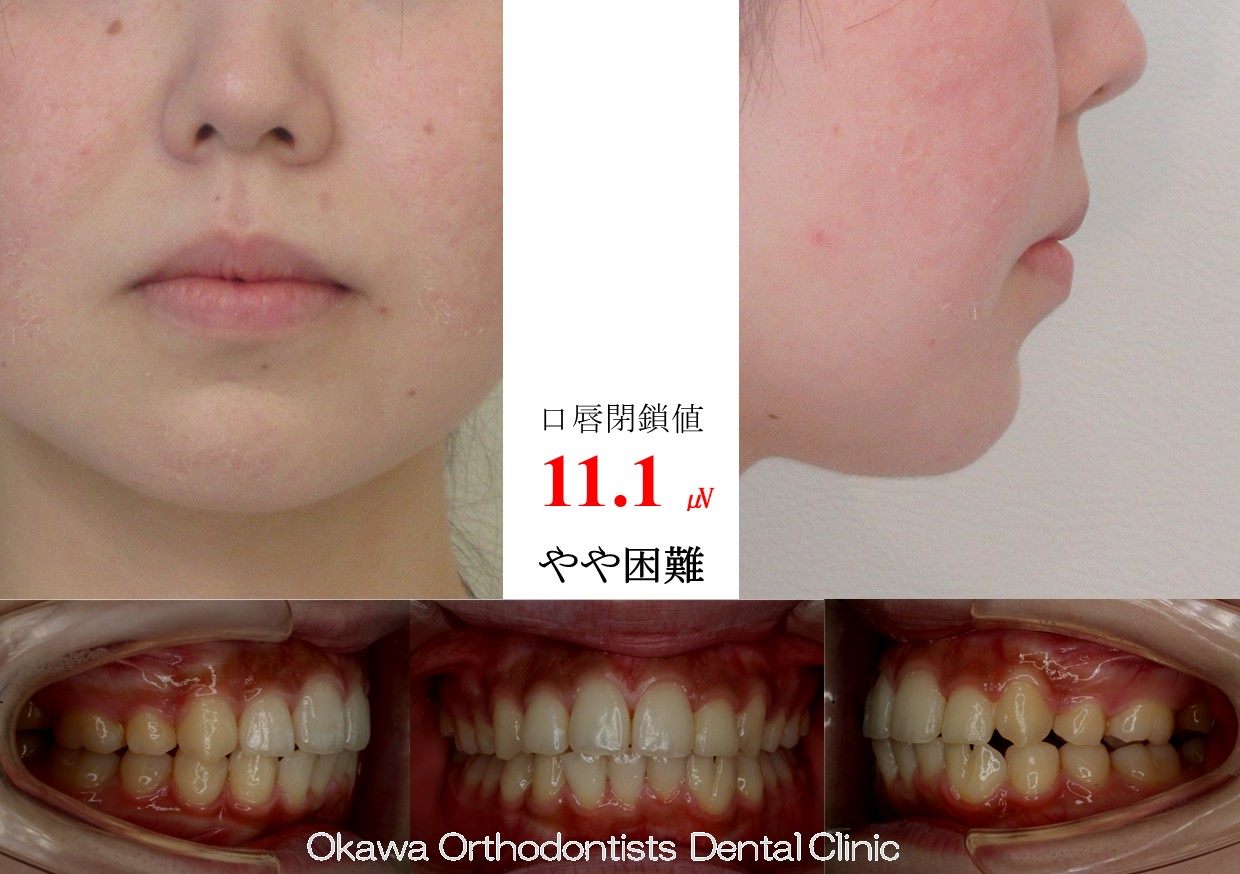 743. 叢生と癒合歯の After 画像