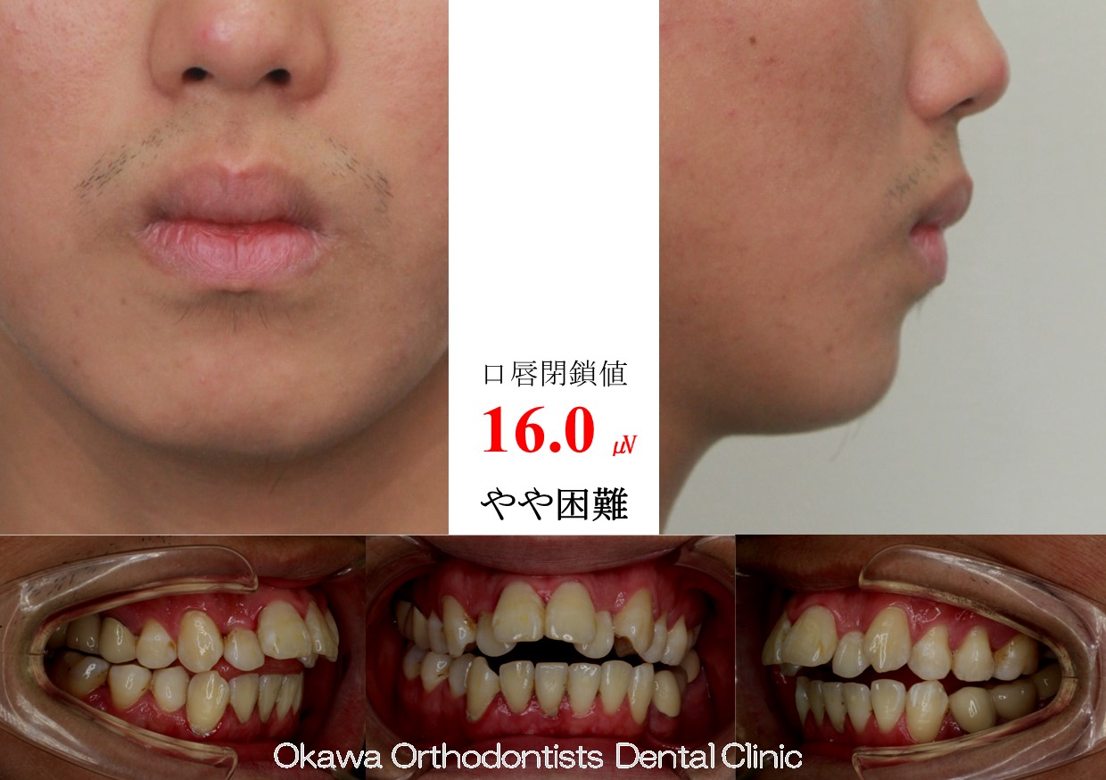 741. 海外の補綴物で苦労の Before 画像