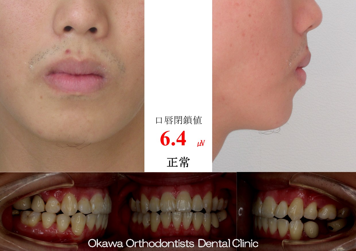 741. 海外の補綴物で苦労の After 画像