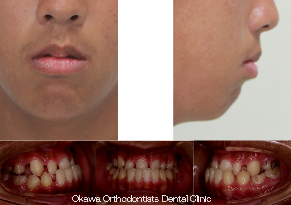 748. ７歯欠損と顎変形症の Before 画像