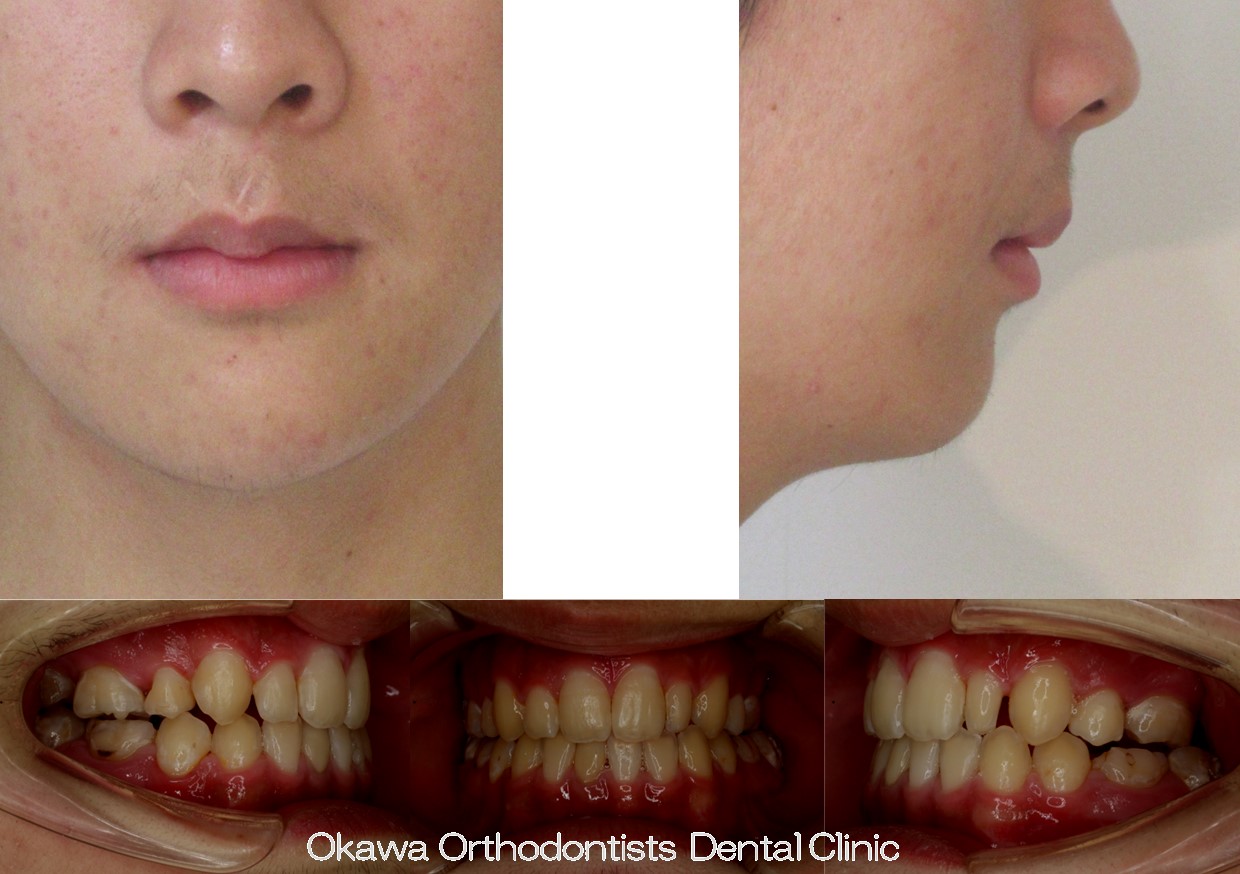 748. ７歯欠損と顎変形症の After 画像