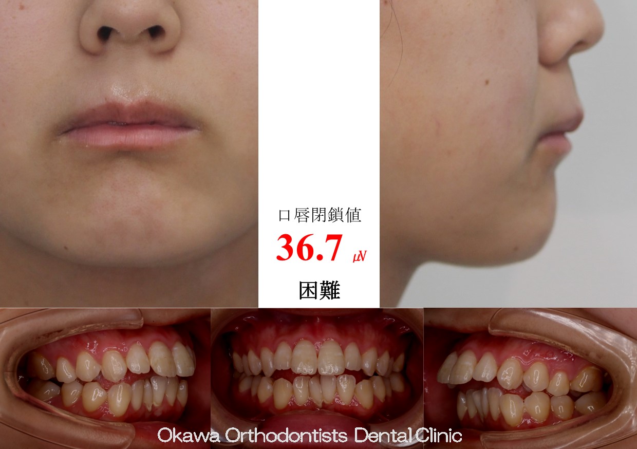 749. 片顎抜歯の上顎前突の Before 画像