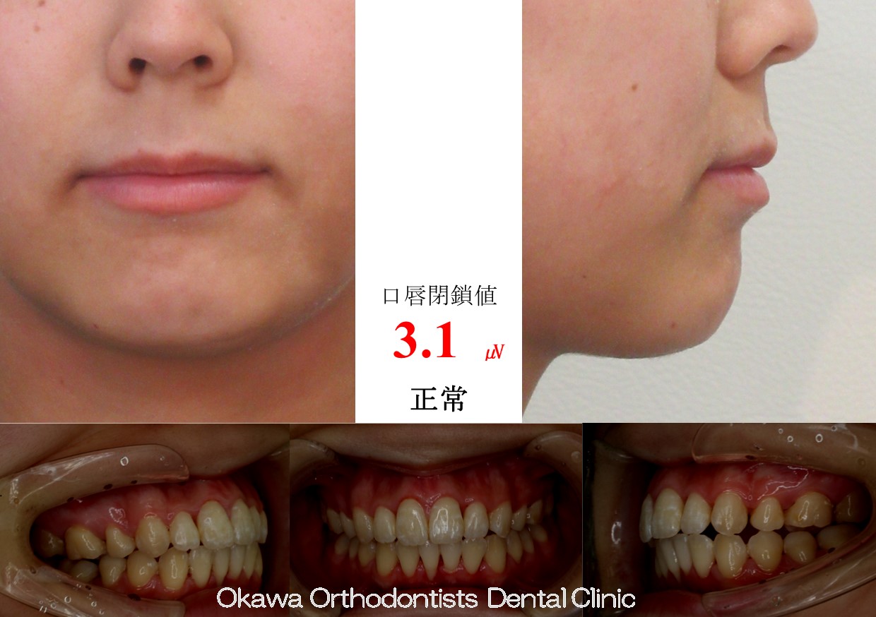 749. 片顎抜歯の上顎前突の After 画像