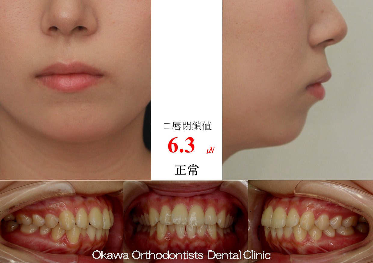 750. 軽度な上下顎前突の Before 画像
