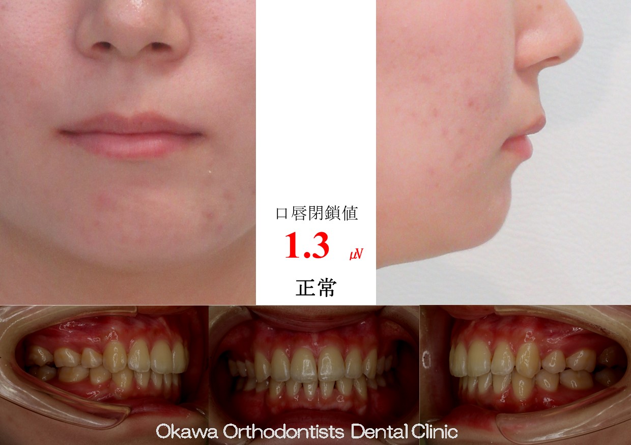 750. 軽度な上下顎前突の After 画像