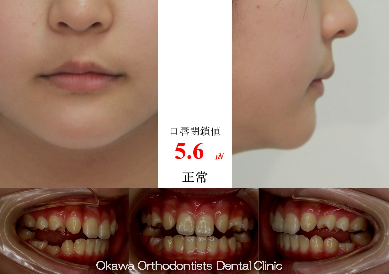 746. ５歯先天欠如と開咬の Before 画像