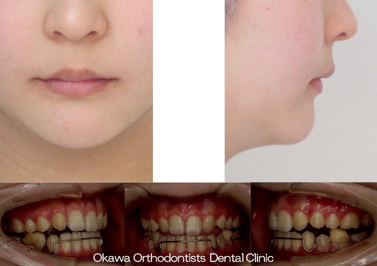 746. ５歯先天欠如と開咬の After 画像