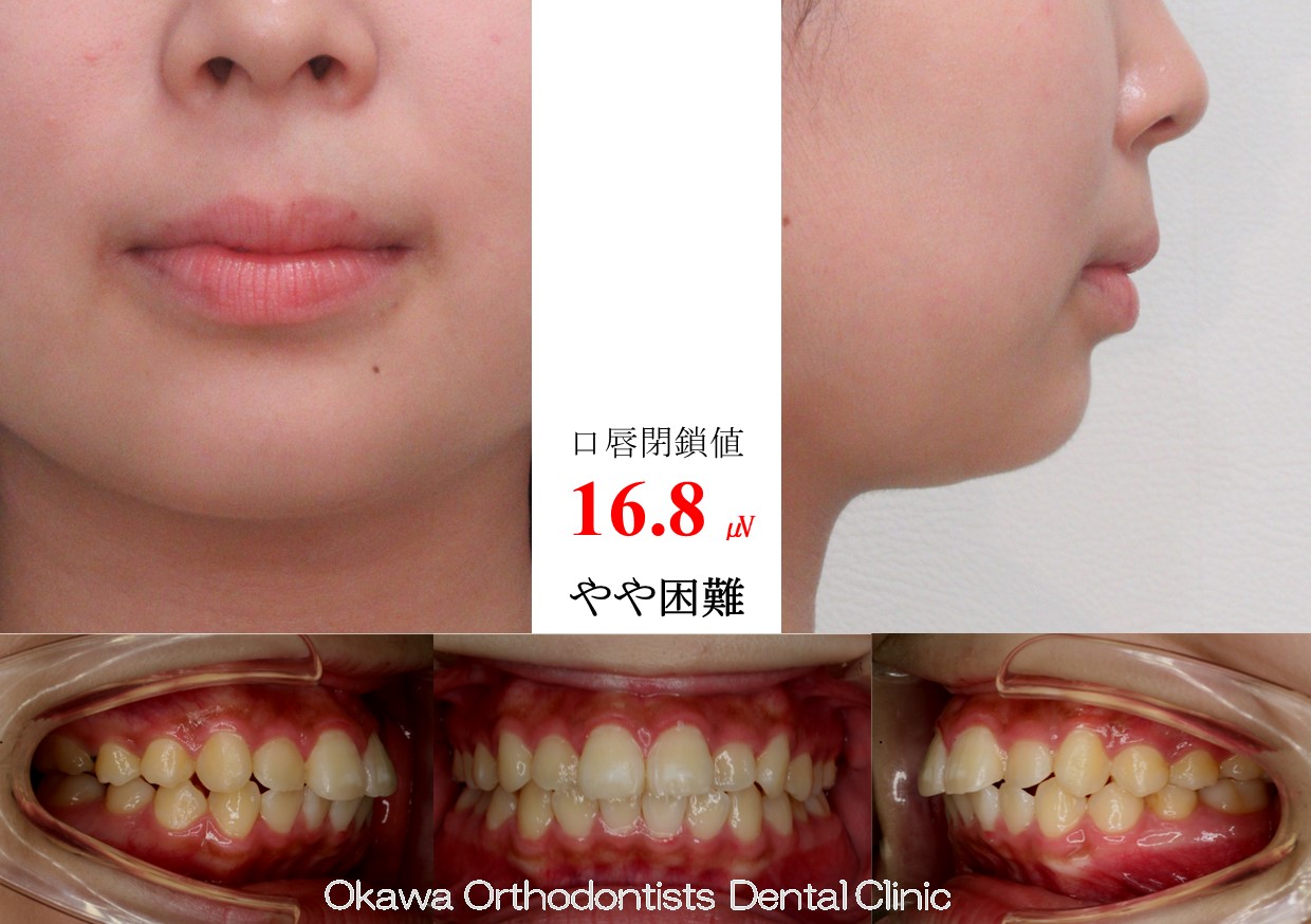 747. 口元が出ているの Before 画像