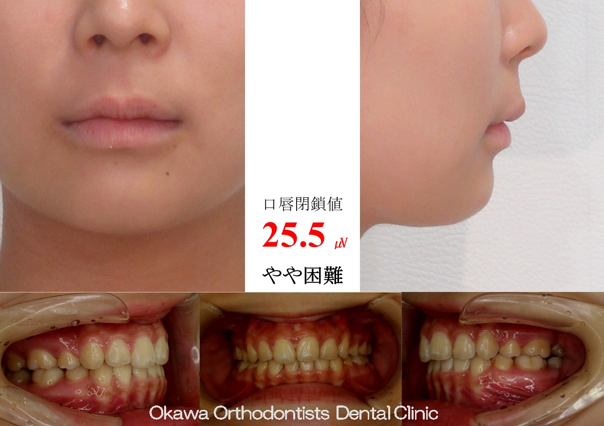 747. 口元が出ているの After 画像