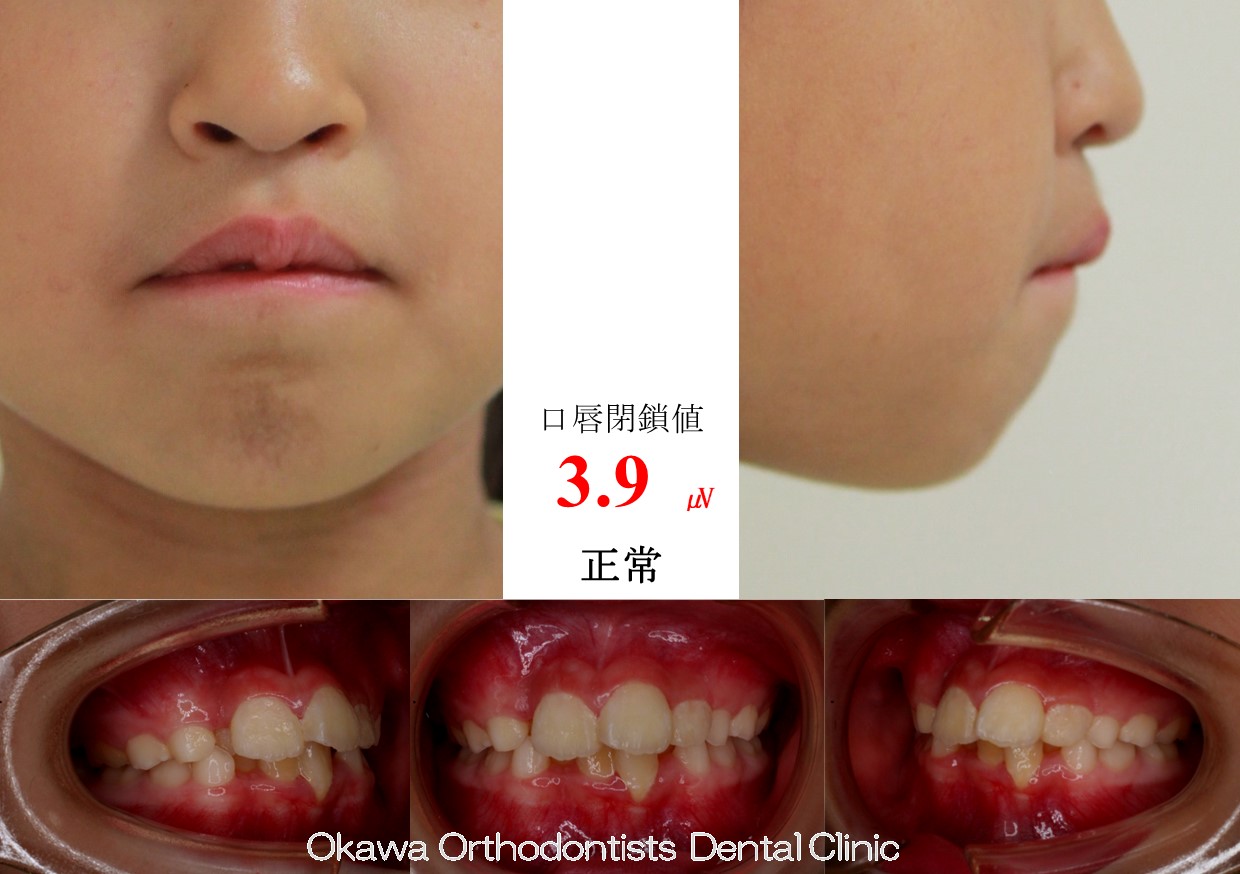 752. 叢生と上顎前突の Before 画像