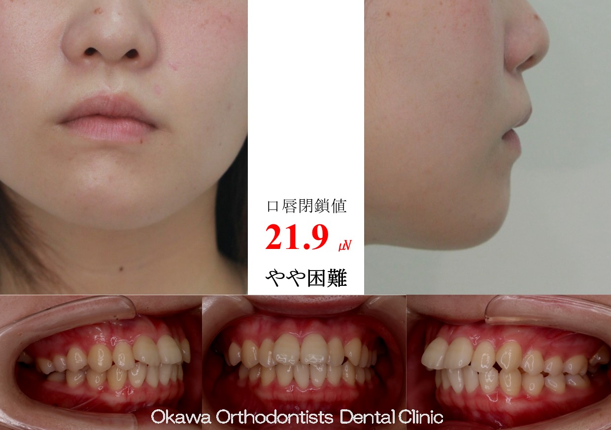 754. 長期間治療の Before 画像