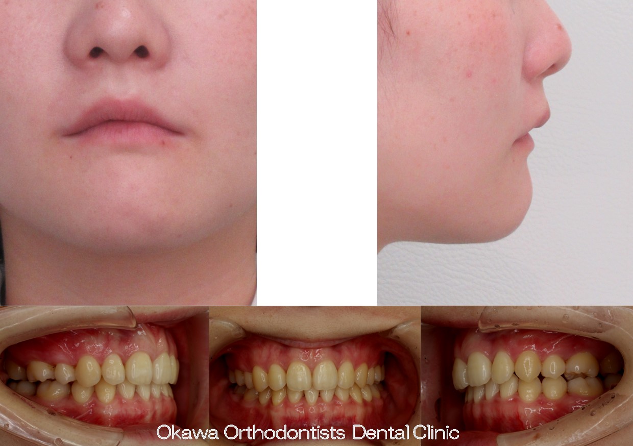 754. 長期間治療の After 画像