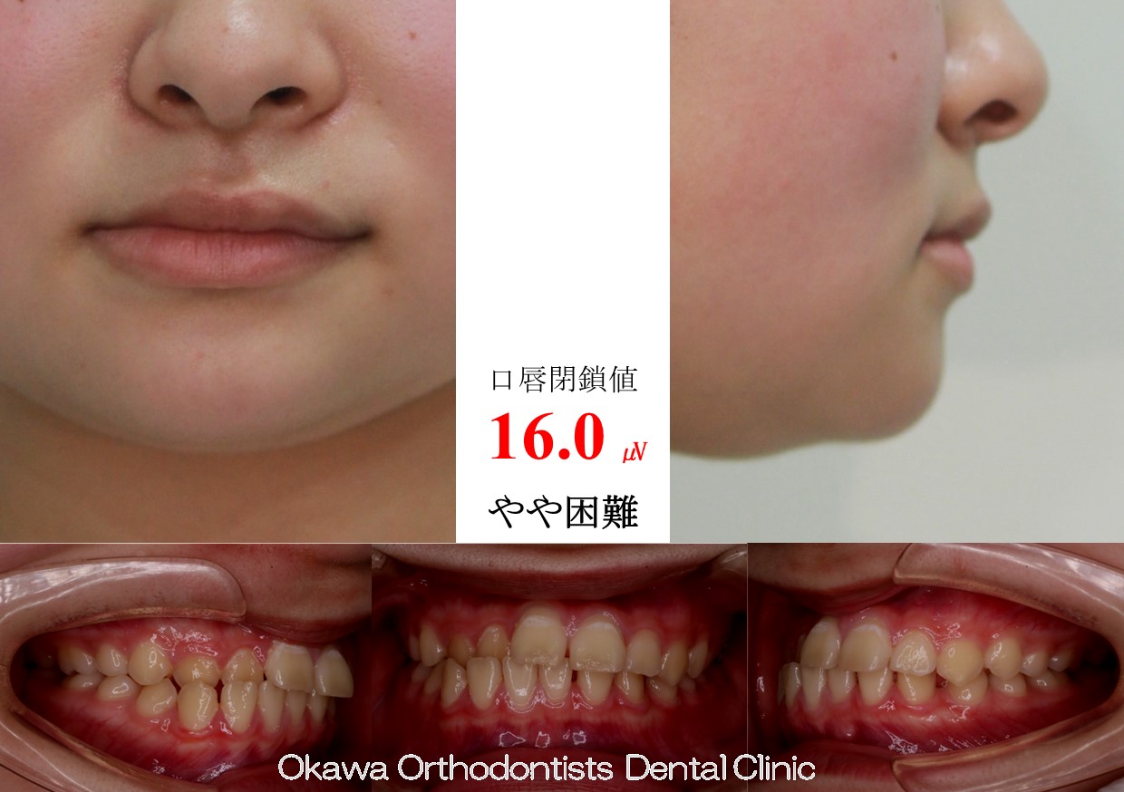 755. 手術なし、抜歯なしの Before 画像