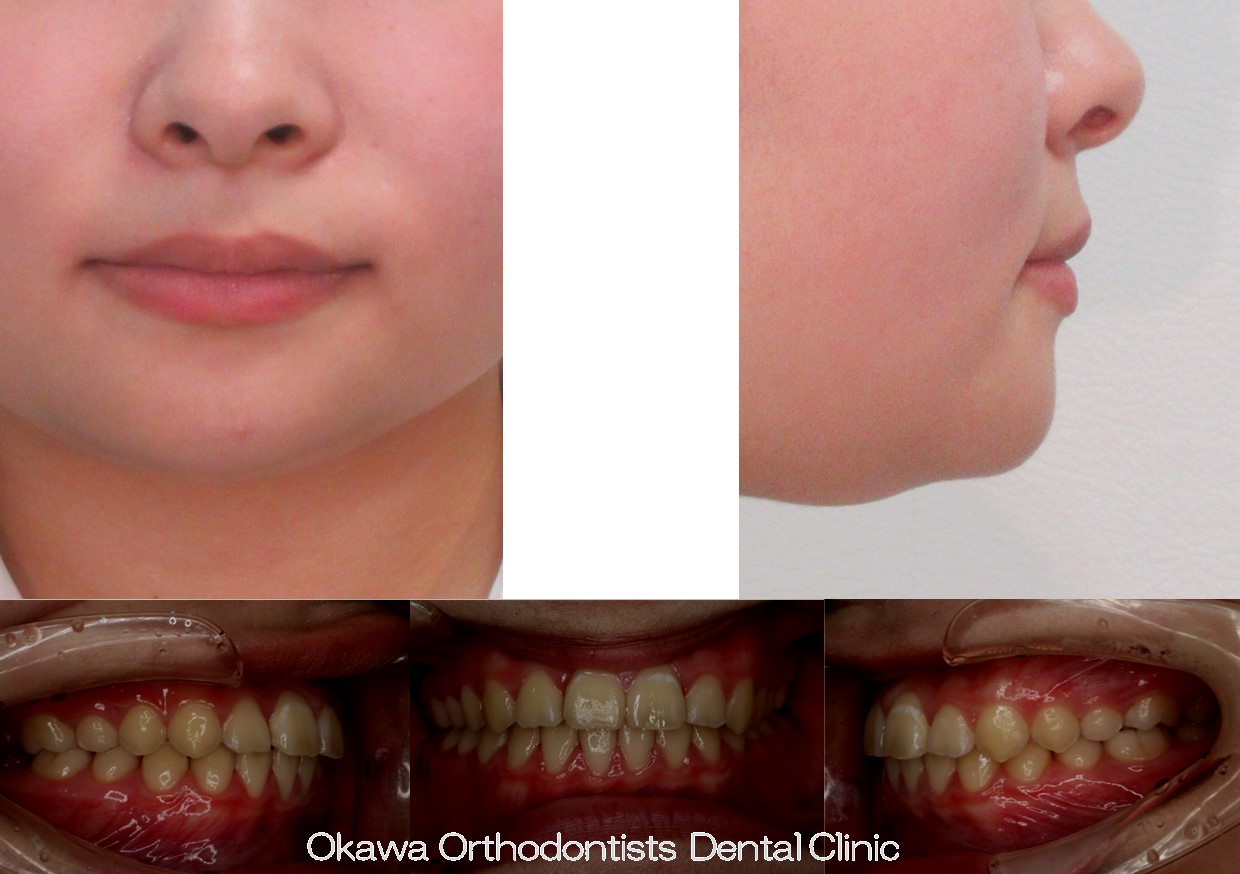 755. 手術なし、抜歯なしの After 画像