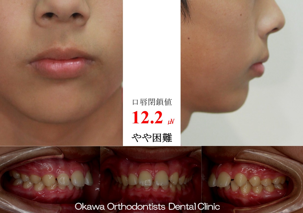 753. 左上側切歯先欠の Before 画像