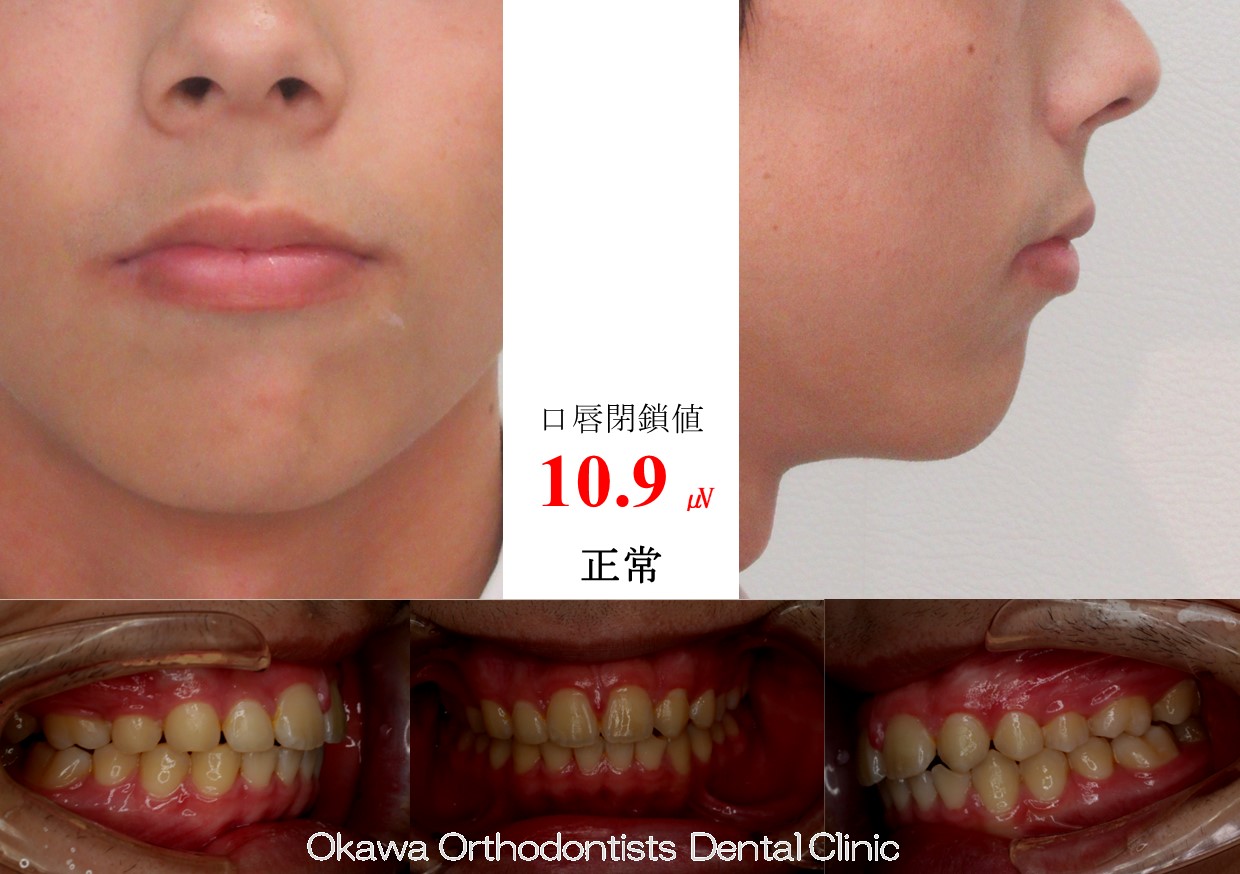 753. 左上側切歯先欠の After 画像