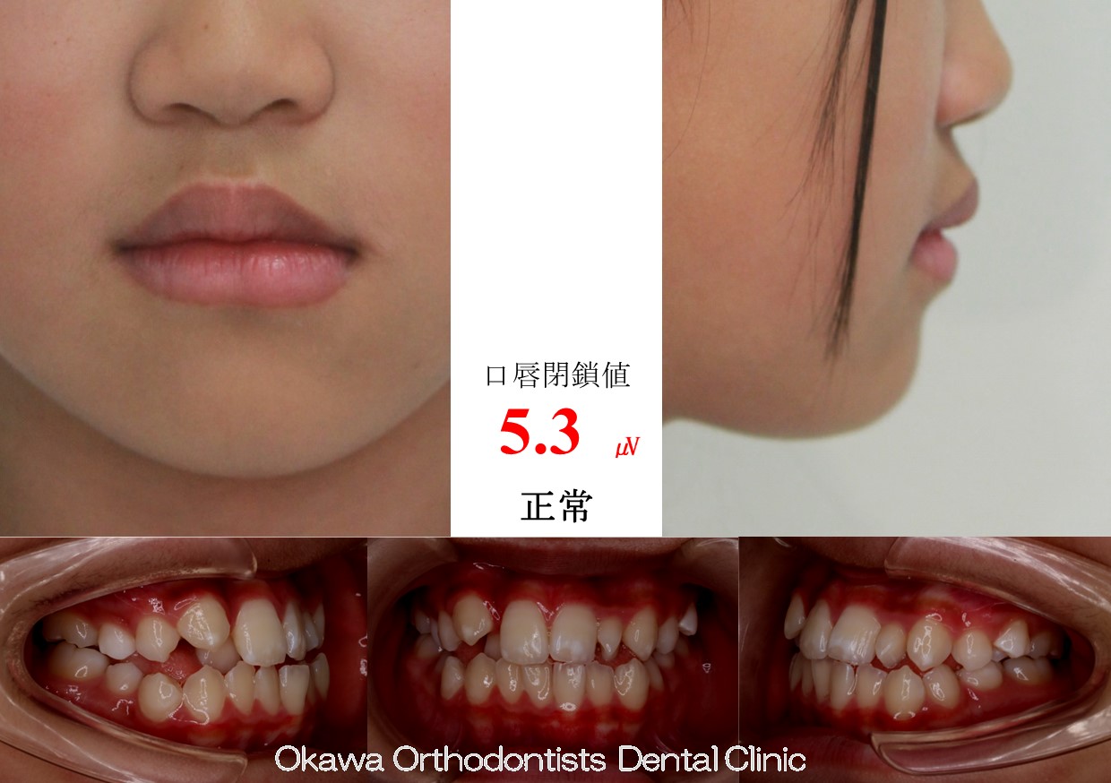 763. 叢生の Before 画像