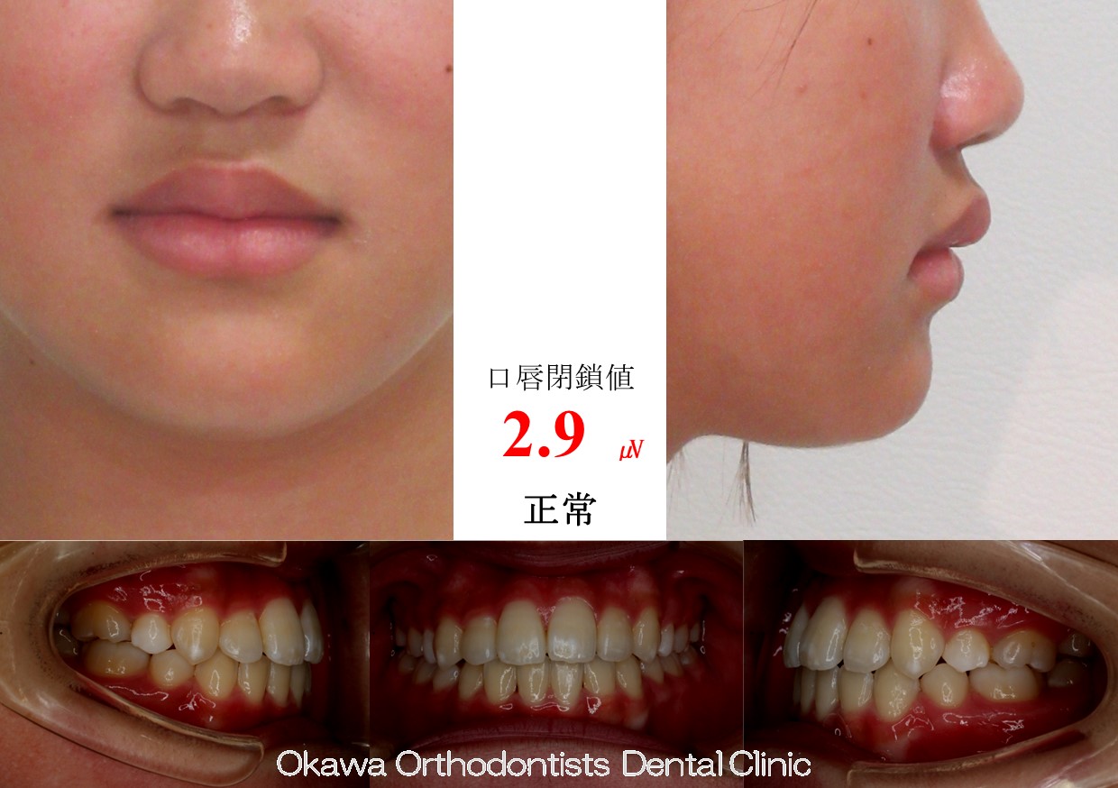 763. 叢生の After 画像