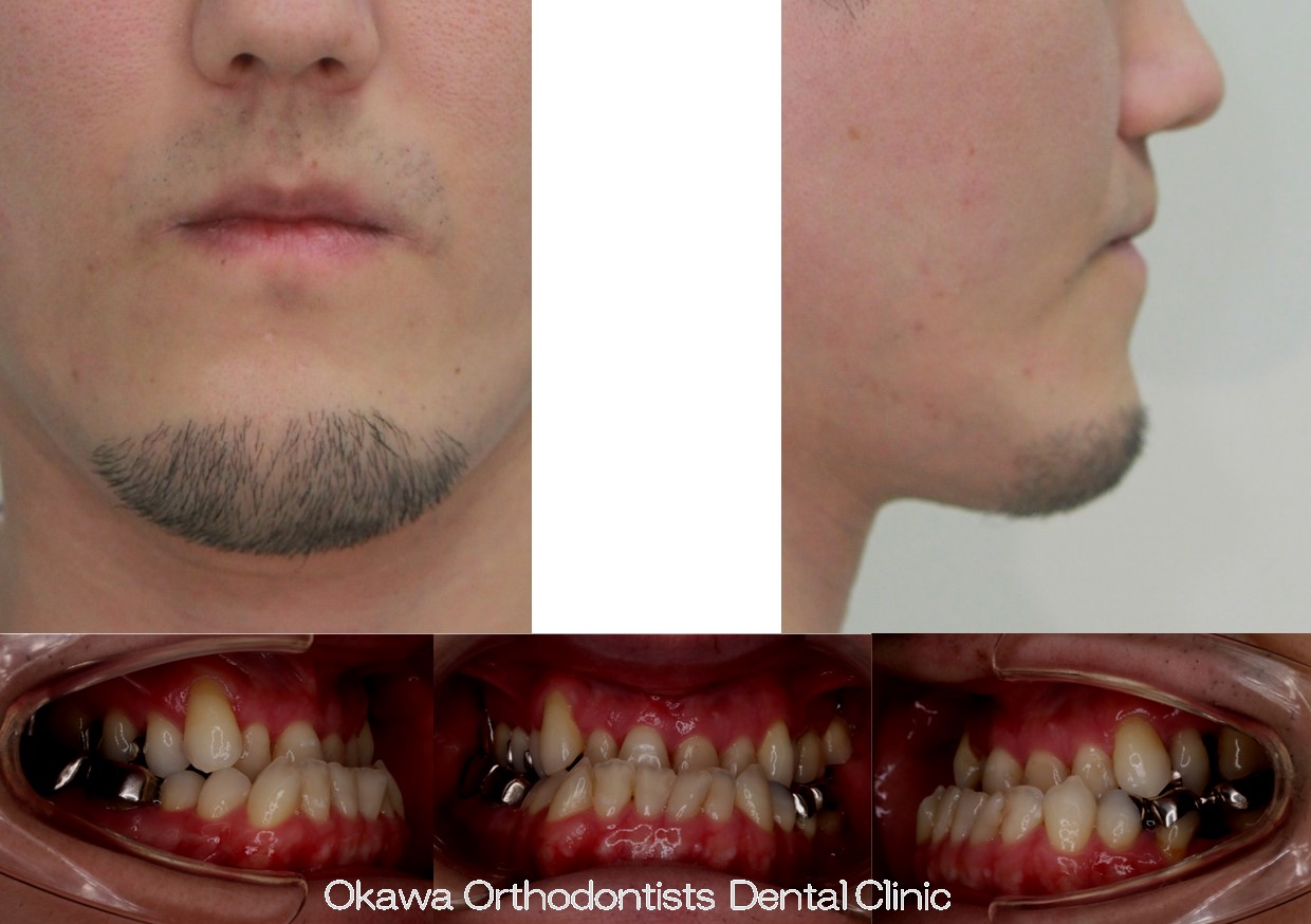 760. 補綴物が多いの Before 画像