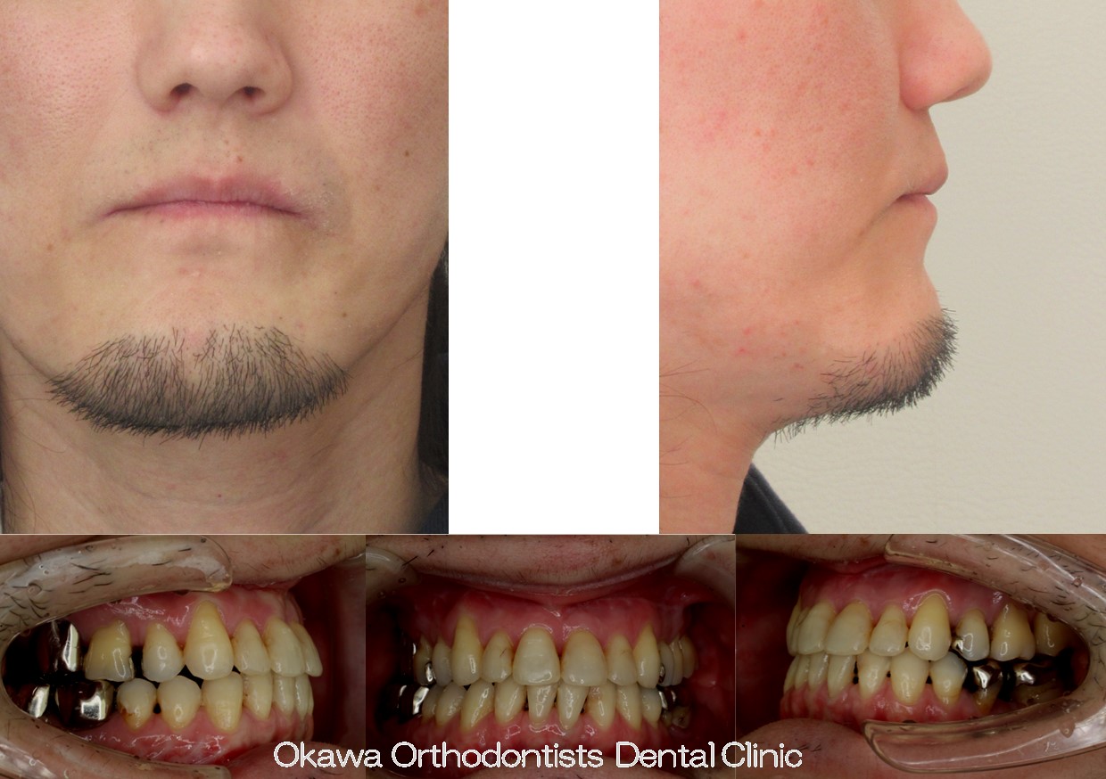 760. 補綴物が多いの After 画像