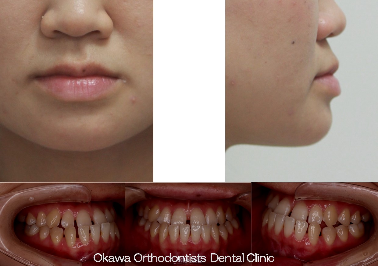 756. 手術併用下顎前突の Before 画像