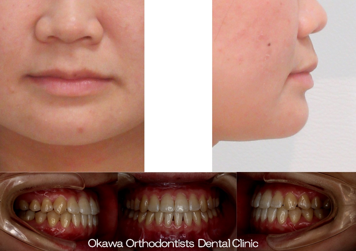 756. 手術併用下顎前突の After 画像