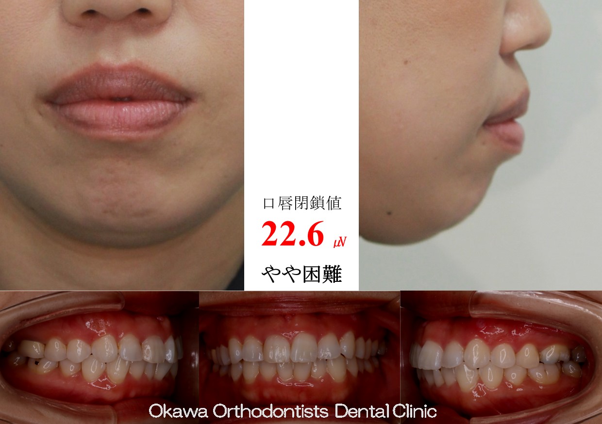 761. 口元、ガミーの Before 画像