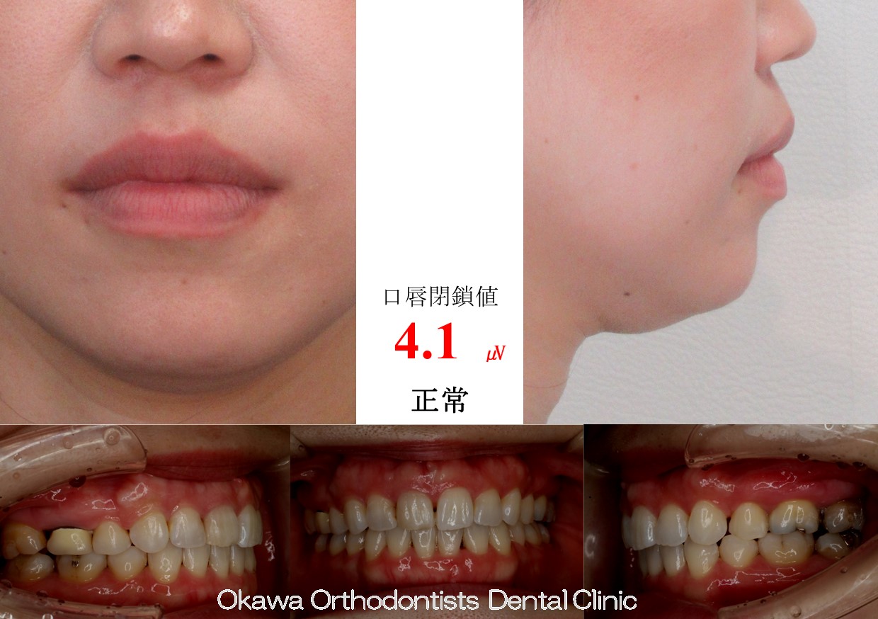 761. 口元、ガミーの After 画像