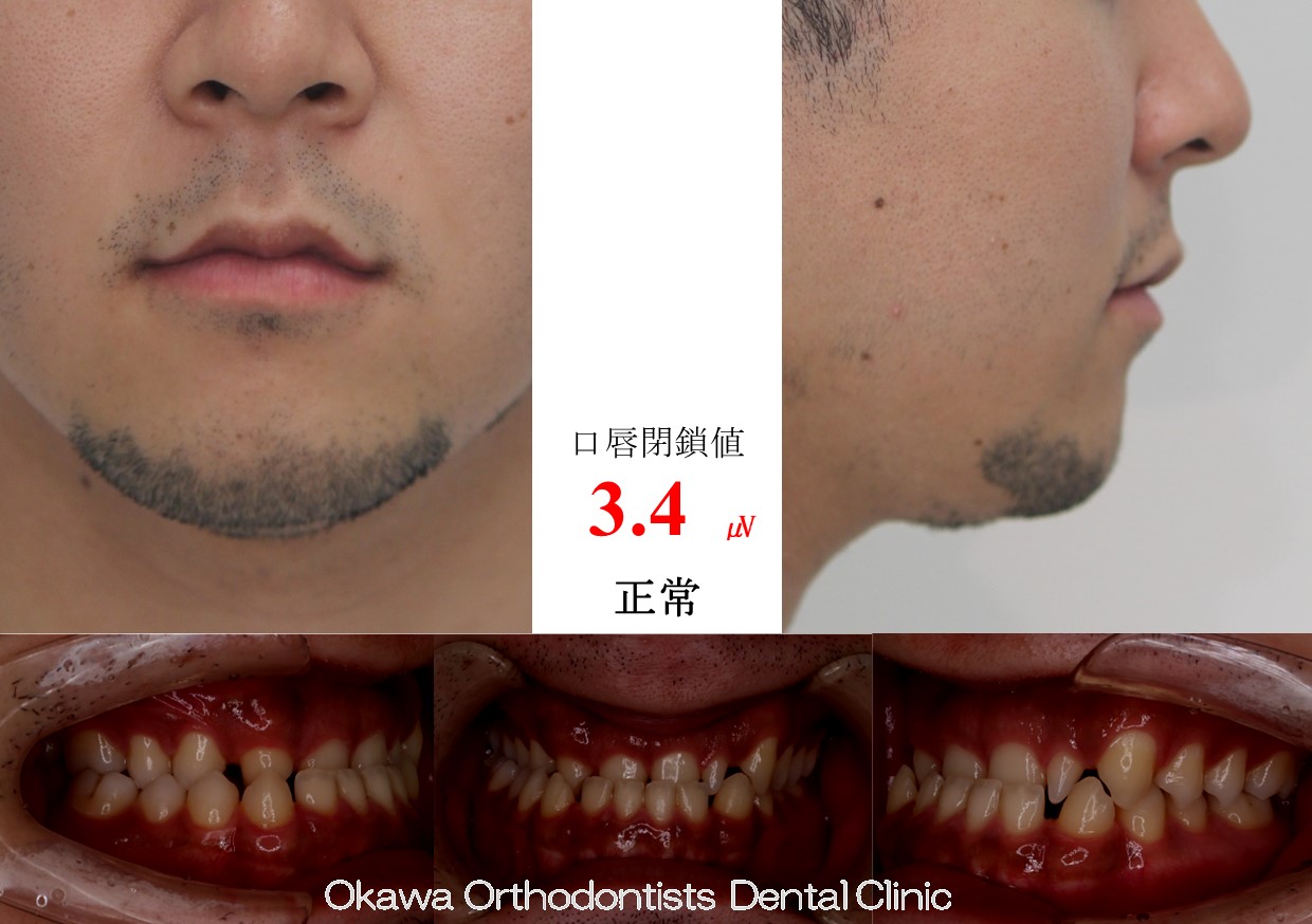 762. 反対咬合　先欠・矮小歯の Before 画像