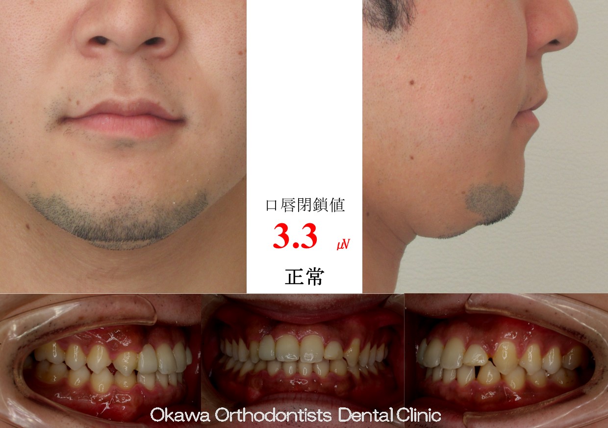 762. 反対咬合　先欠・矮小歯の After 画像