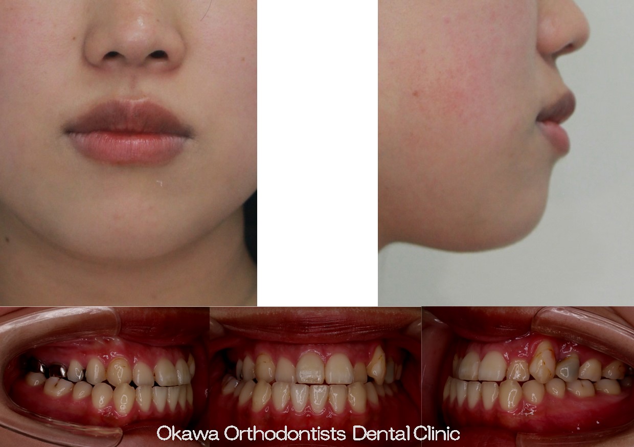 759. 手術併用顎のずれの Before 画像