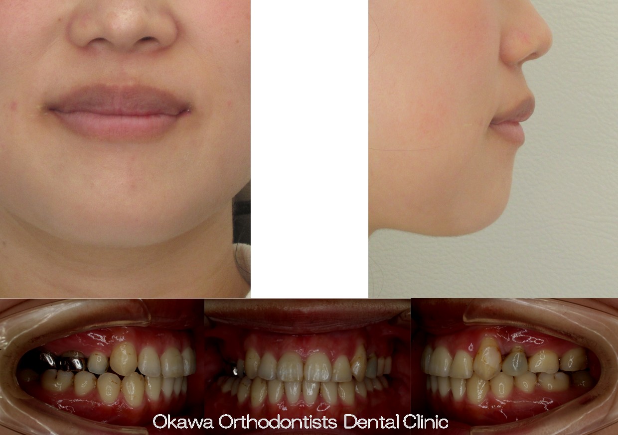 759. 手術併用顎のずれの After 画像