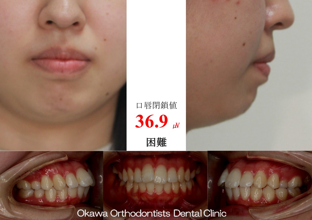 758. 口唇閉鎖困難の Before 画像