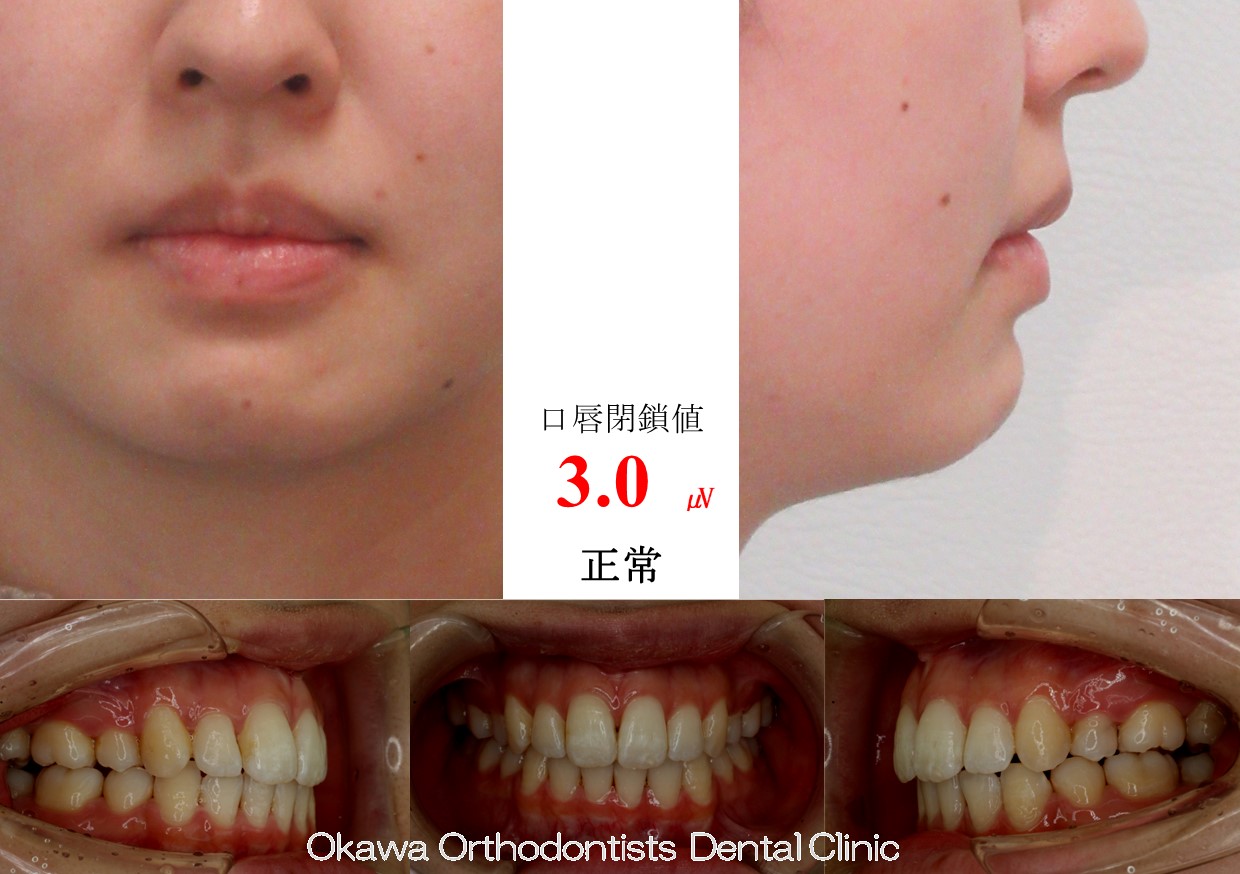 758. 口唇閉鎖困難の After 画像