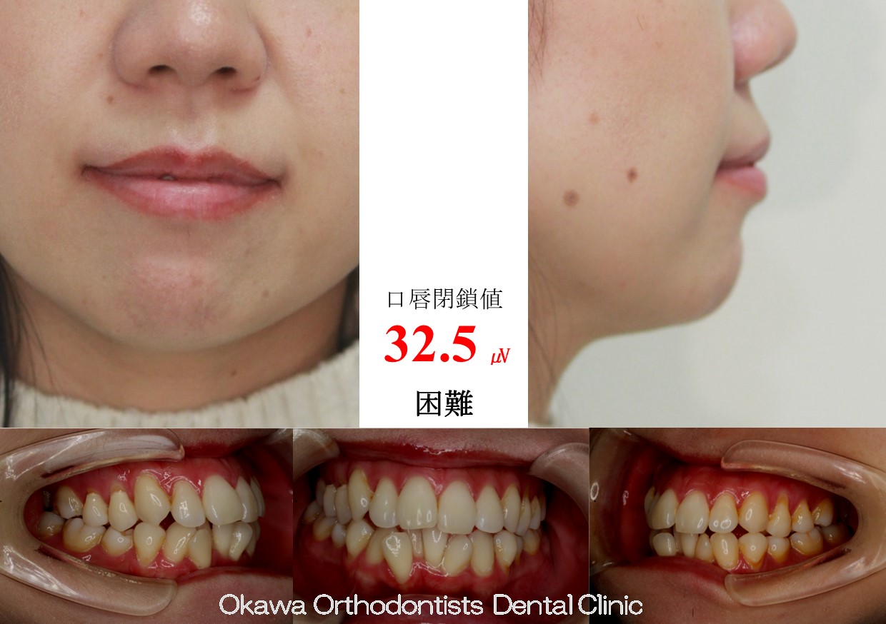 757. 下顎前歯歯肉退縮の Before 画像