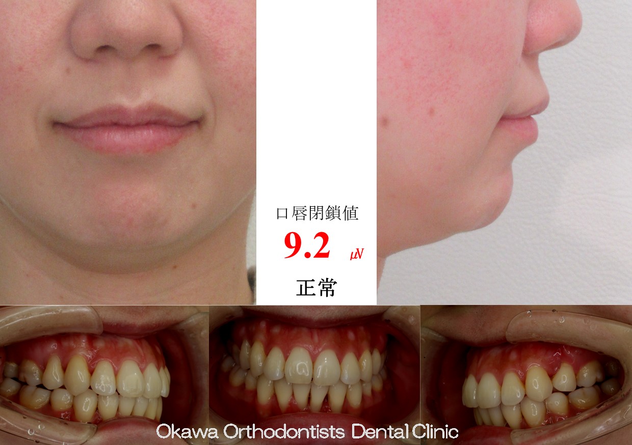 757. 下顎前歯歯肉退縮の After 画像