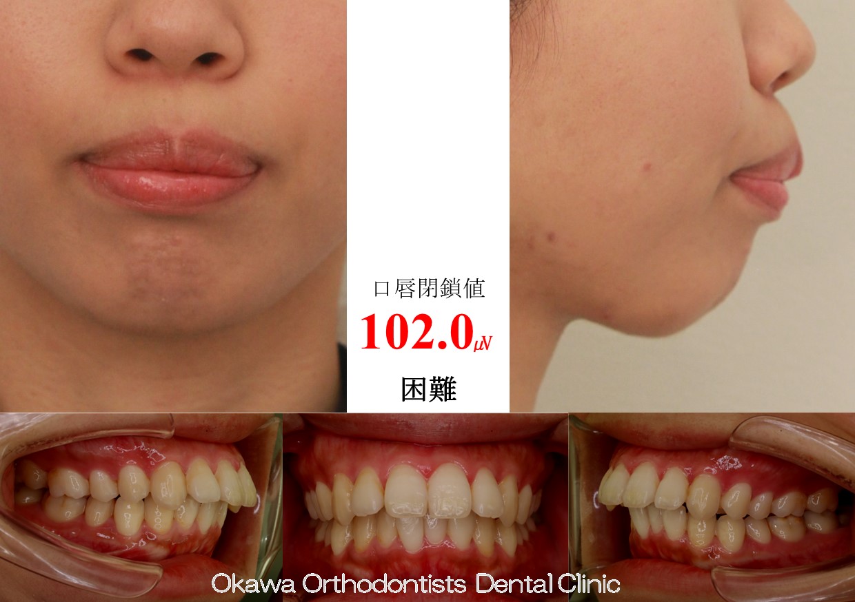 765.口元が出ているの Before 画像