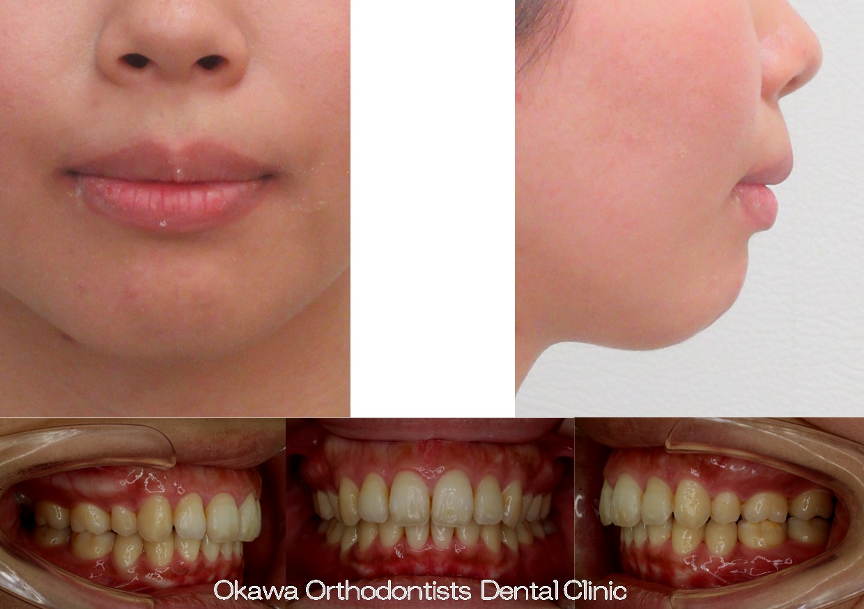 765.口元が出ているの After 画像