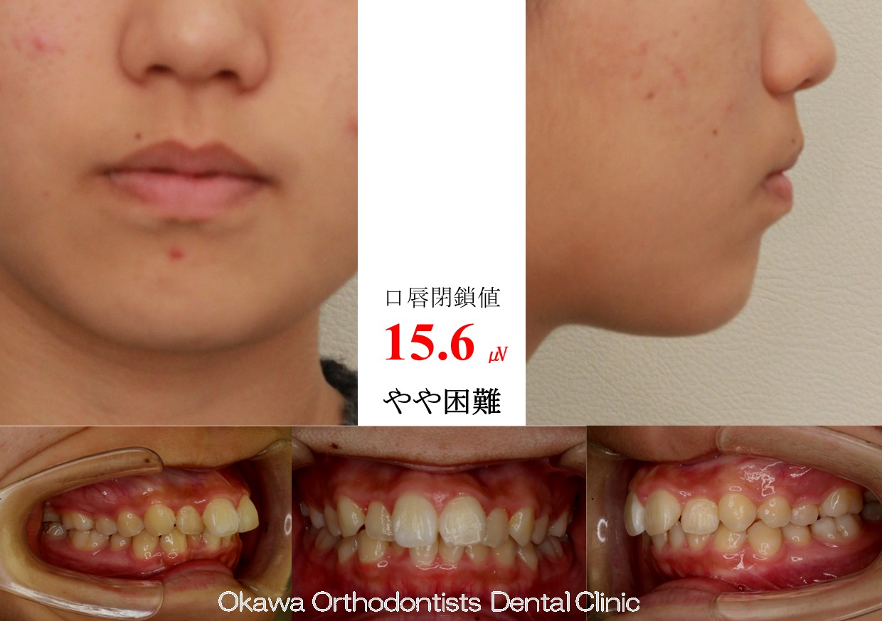 766.叢生の Before 画像