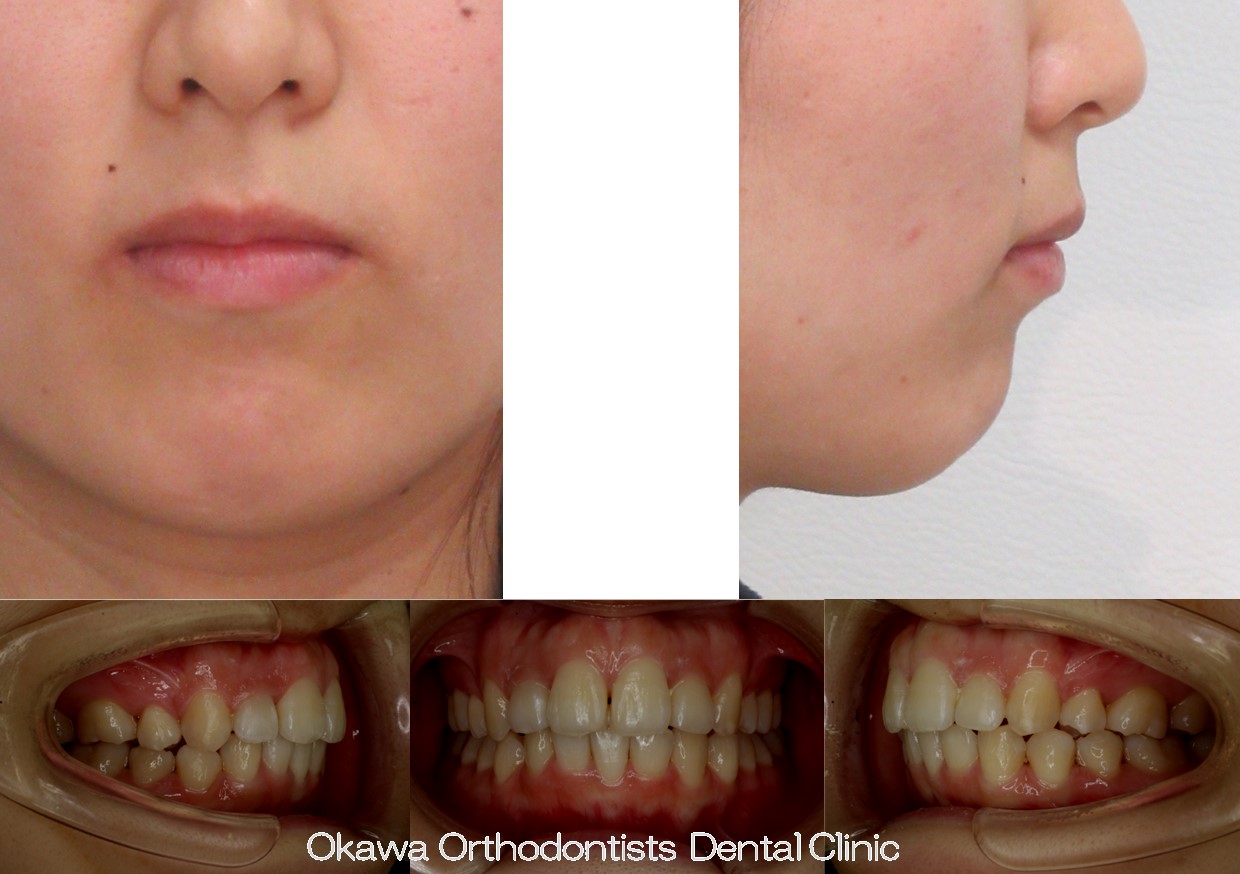 767.上顎前突と下顎前歯3本の After 画像